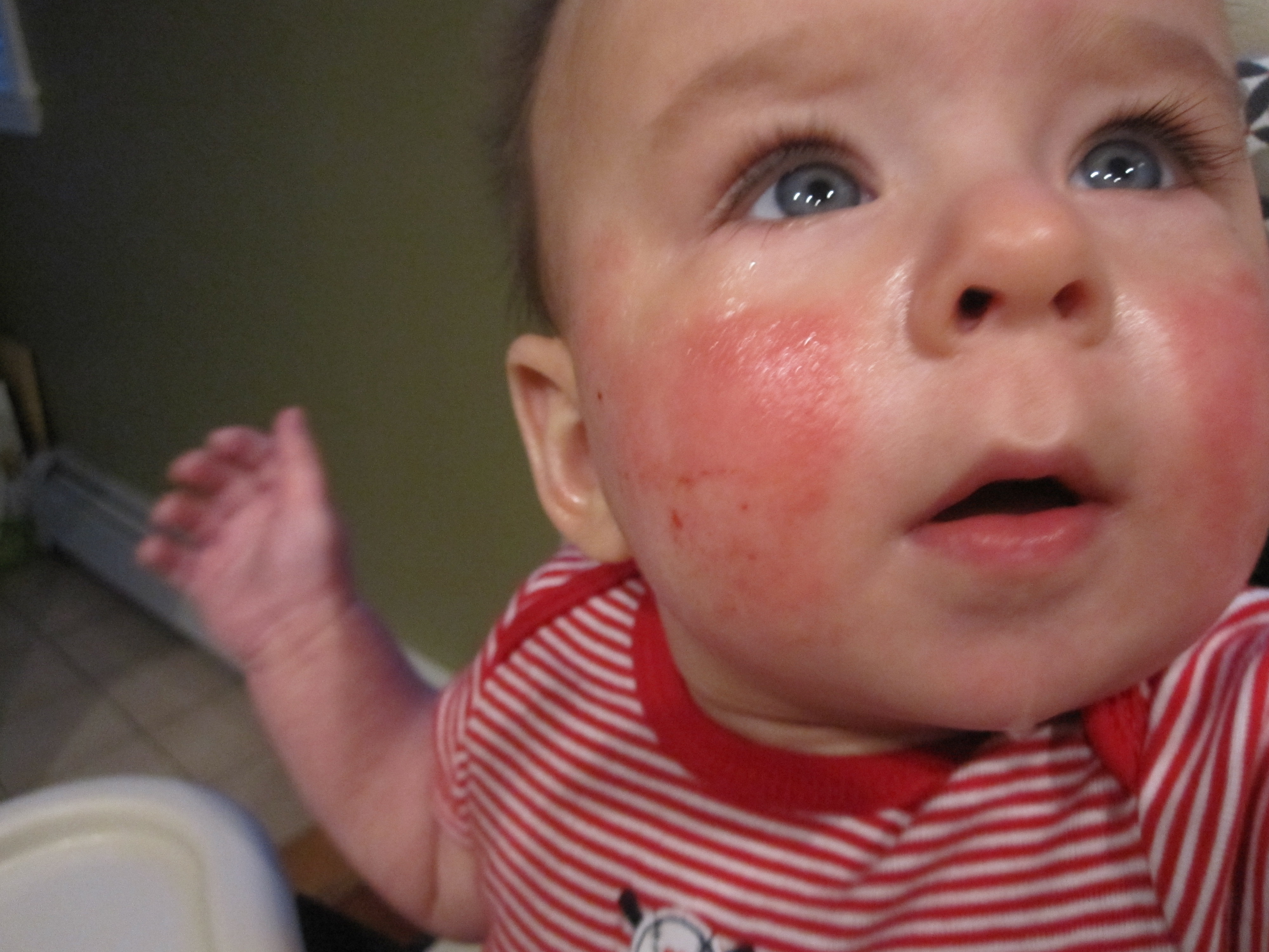 Guide to Rashes | Parenting